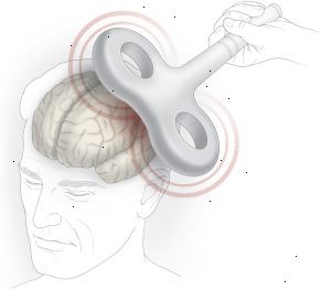 Estimulación transcraneal Estimulación transcraneal