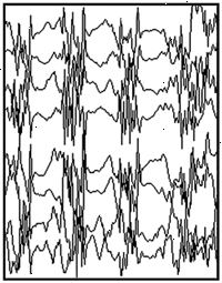 Convulsión generalizada EEG Convulsión generalizada EEG