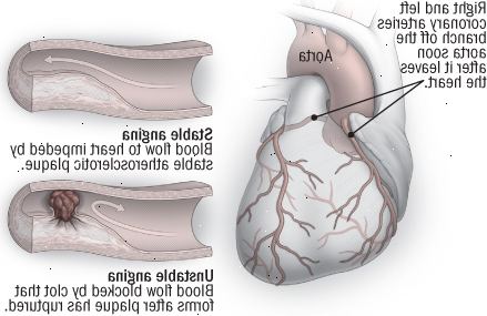 La angina estable e inestable La angina estable e inestable