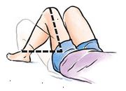 La rodilla del lado afectado debe mirar hacia adelante o girar un poco. No gire la rodilla hacia adentro. La rodilla del lado afectado debe mirar hacia adelante o girar un poco. No gire la rodilla hacia adentro.