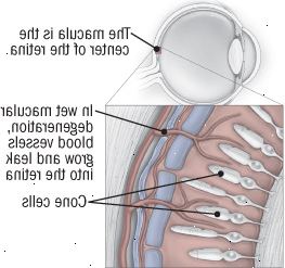 La degeneración macular La degeneración macular