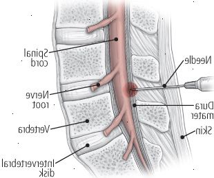 Una mirada a dos terapias de inyección: inyección epidural de esteroides Una mirada a dos terapias de inyección: inyección epidural de esteroides