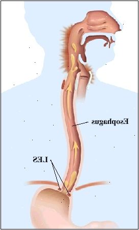 Contorno de una figura humana que muestra la anatomía del sistema digestivo superior, desde la boca hasta el estómago. Esófago pasa a través del diafragma para conectarse al estómago. Débil LES está abierto y las flechas muestran el movimiento de los contenidos estomacales hacia arriba en el esófago y la parte posterior de la garganta. Parte posterior de la garganta está inflamada. Contorno de una figura humana que muestra la anatomía del sistema digestivo superior, desde la boca hasta el estómago. Esófago pasa a través del diafragma para conectarse al estómago. Débil LES está abierto y las flechas muestran el movimiento de los contenidos estomacales hacia arriba en el esófago y la parte posterior de la garganta. Parte posterior de la garganta está inflamada.