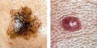 Fotografia comparando un lunar normal y melanoma enseñado asimetría Fotografia comparando un lunar normal y melanoma enseñado asimetría