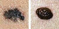 Fotografia comparando un lunar normal y melanoma enseñado bordes irregulares Fotografia comparando un lunar normal y melanoma enseñado bordes irregulares