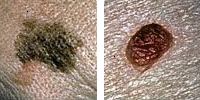 Fotografia comparando un lunar normal y melanoma enseñado diámetro Fotografia comparando un lunar normal y melanoma enseñado diámetro