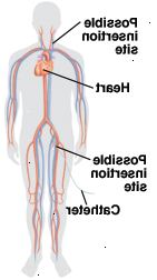 La inserción puede realizarse en la ingle o el cuello La inserción puede realizarse en la ingle o el cuello