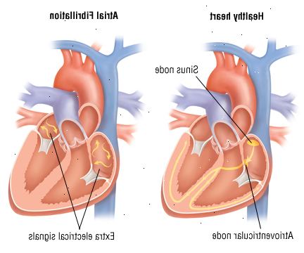 La fibrilación auricular 1 La fibrilación auricular 1