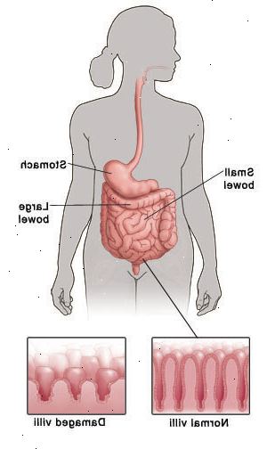Contorno de una figura humana que muestra el sistema digestivo y señalando estómago, intestino delgado, intestino grueso y. Detalle muestra vellosidades normales como tallos carnosos de dedos que recubren el intestino compararon con pocas palabras, las vellosidades dañadas.
