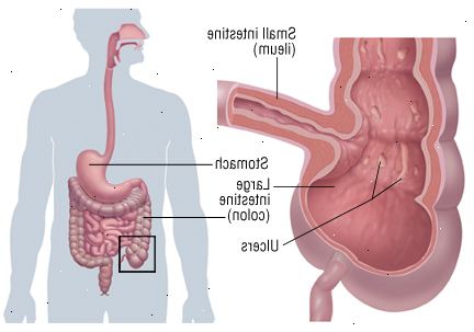 Crohn Crohn