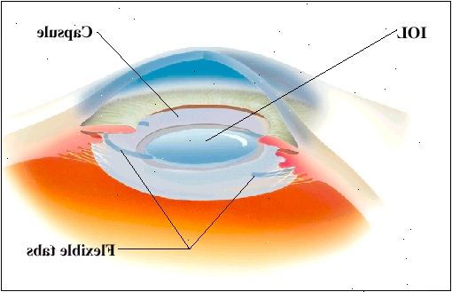 La LIO se desarrolla a medida que se inserta en la cápsula natural del ojo. Lengüetas flexibles tienen la IOL en su lugar.