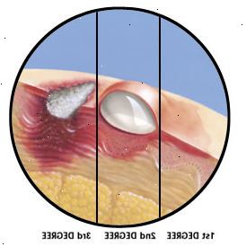 La sección transversal de la piel que muestra en primer grado a quemar la capa superior perjudicial de piel, quemaduras de segundo grado profundas capas dañinos de la piel y la formación de ampollas y quemaduras de tercer grado la destrucción de las capas superiores de la piel y los tejidos profundos perjudiciales. La sección transversal de la piel que muestra en primer grado a quemar la capa superior perjudicial de piel, quemaduras de segundo grado profundas capas dañinos de la piel y la formación de ampollas y quemaduras de tercer grado la destrucción de las capas superiores de la piel y los tejidos profundos perjudiciales.