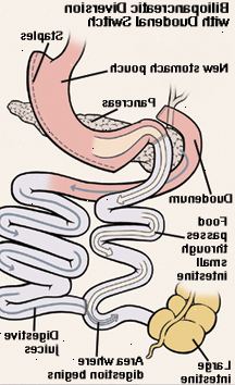 Vista frontal del estómago y el duodeno. Estómago se ha cortado y grapado. Corte el extremo del intestino delgado ha sido criado para conectarse al estómago. Duodeno ha sido cortado y vuelto a unir al intestino delgado. La flecha muestra la comida pasa del estómago al intestino delgado acortado. Otra flecha muestra el camino de los jugos digestivos del estómago a través del duodeno y en el intestino delgado. La digestión comienza en el intestino delgado. Vista frontal del estómago y el duodeno. Estómago se ha cortado y grapado. Corte el extremo del intestino delgado ha sido criado para conectarse al estómago. Duodeno ha sido cortado y vuelto a unir al intestino delgado. La flecha muestra la comida pasa del estómago al intestino delgado acortado. Otra flecha muestra el camino de los jugos digestivos del estómago a través del duodeno y en el intestino delgado. La digestión comienza en el intestino delgado.