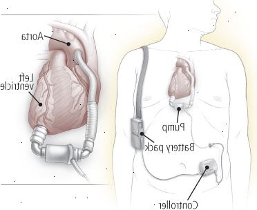 Dispositivo de asistencia ventricular (VAD) Dispositivo de asistencia ventricular (VAD)