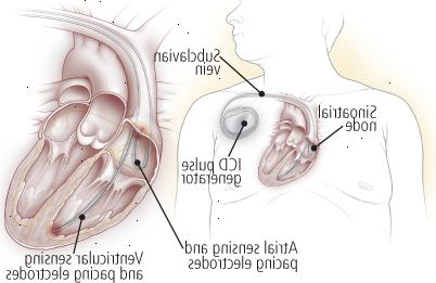 Desfibriladores cardíacos implantables Desfibriladores cardíacos implantables