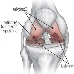 La osteoartritis de la rodilla La osteoartritis de la rodilla