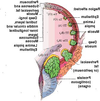 La estadificación del cáncer de vejiga La estadificación del cáncer de vejiga