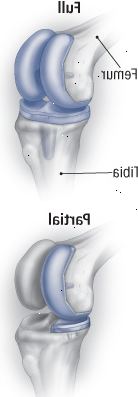 El reemplazo de rodilla El reemplazo de rodilla