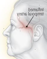 Cuando le duele al tacto: arteritis temporal Cuando le duele al tacto: arteritis temporal
