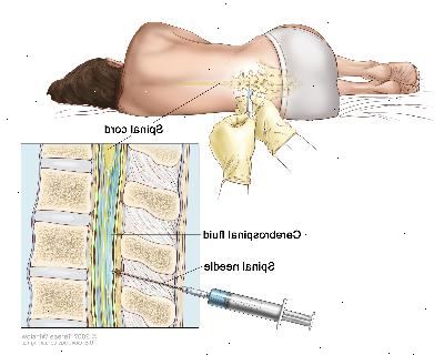 La punción lumbar. Un paciente se encuentra en una posición encorvada sobre una mesa. Después de adormecer un área pequeña en la parte posterior más baja, una aguja espinal (una aguja larga y delgada) se inserta en la parte inferior de la columna vertebral para extraer líquido cefalorraquídeo (LCR, se muestra en azul). El líquido puede ser enviado a un laboratorio para su análisis.