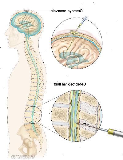 La quimioterapia intratecal. Los fármacos anticancerosos se inyectan en el espacio intratecal, que es el espacio que contiene el líquido cefalorraquídeo (LCR, se muestra en azul). Hay dos maneras diferentes de hacer esto. Una forma, que se muestra en la parte superior de la imagen, consiste en inyectar los medicamentos dentro del reservorio Ommaya (un recipiente en forma de cúpula que se ubica bajo el cuero cabelludo mediante una cirugía; mismo contiene los medicamentos que circularán a través de un pequeño tubo en el cerebro ). La otra forma, que se muestra en la parte inferior de la imagen, consiste en inyectar los medicamentos directamente en el LCR en la parte inferior de la columna vertebral, después de una pequeña área en la parte posterior más baja se adormece.
