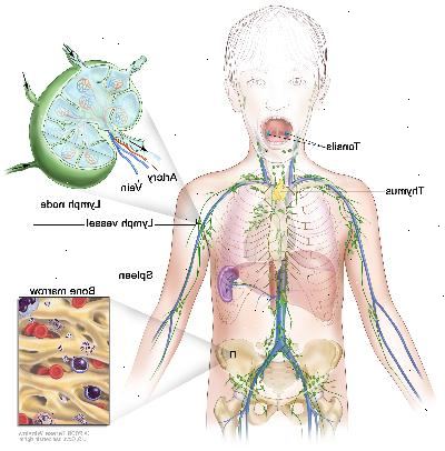 Sistema linfático; dibujo muestra los vasos linfáticos y los órganos linfáticos, incluso los ganglios linfáticos, las amígdalas, el timo, el bazo y la médula ósea. Un recuadro muestra la estructura interior de un ganglio linfático y de los vasos linfáticos adjuntos, con flechas que indican como circula la linfa (un líquido claro) hacia adentro y afuera del ganglio linfático. Otro recuadro muestra una vista ampliada de la médula ósea con células sanguíneas.