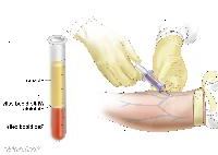 Recuento sanguíneo completo (CBC). La sangre se recoge mediante la inserción de una aguja en una vena y permitir que la sangre fluya hacia un tubo. La muestra de sangre se envía al laboratorio y los glóbulos rojos, los glóbulos blancos y las plaquetas. El RSC se usa para examinar, diagnosticar y vigilar muchas enfermedades diferentes. Recuento sanguíneo completo (CBC). La sangre se recoge mediante la inserción de una aguja en una vena y permitir que la sangre fluya hacia un tubo. La muestra de sangre se envía al laboratorio y los glóbulos rojos, los glóbulos blancos y las plaquetas. El RSC se usa para examinar, diagnosticar y vigilar muchas enfermedades diferentes.