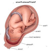 Dibujo que demuestra la placenta previa total Dibujo que demuestra la placenta previa total