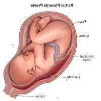 Dibujo que demuestra la placenta previa parcial Dibujo que demuestra la placenta previa parcial