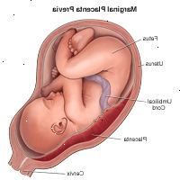 Ilustración de placenta previa marginal Ilustración de placenta previa marginal