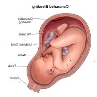 Dibujo que demuestra el sangrado oculto durante el embarazo Dibujo que demuestra el sangrado oculto durante el embarazo