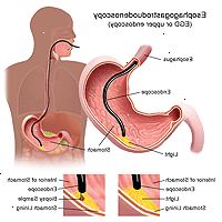 Ilustración de un procedimiento de esofagogastroduodenoscopia Ilustración de un procedimiento de esofagogastroduodenoscopia