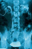 Imagen de una película pielografía intravenosa Imagen de una película pielografía intravenosa