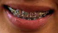 Imagen de una boca sonriente con los apoyos