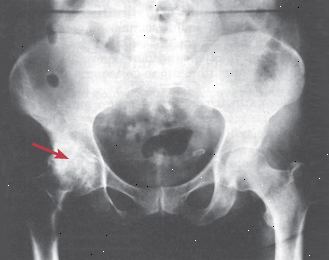 La osteoartritis de la cadera La osteoartritis de la cadera