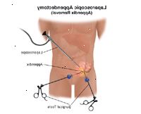 Ilustración de la laparoscopia Ilustración de la laparoscopia