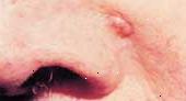 Los carcinomas de células basales forman en lugares expuestos al sol y mirar planteadas y nacarados.