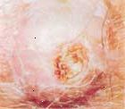 Los carcinomas de células escamosas pueden formar en lugares expuestos al sol, o en otros lugares.