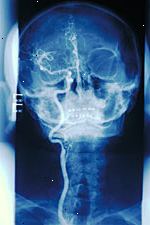 Imagen de una angiografía carotídea Imagen de una angiografía carotídea