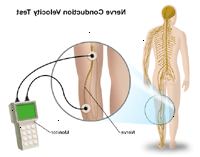 Un ejemplo de una prueba de velocidad de conducción nerviosa Un ejemplo de una prueba de velocidad de conducción nerviosa