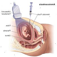 Dibujo que demuestra la amniocentesis