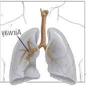 Dos formas de asma restringe la respiración Dos formas de asma restringe la respiración