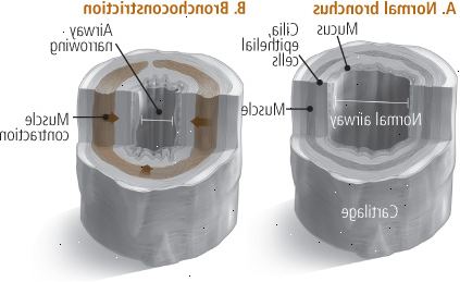 Broncoconstricción Broncoconstricción