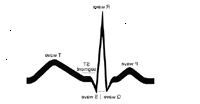 Ilustración de un trazado básico de un ECG Ilustración de un trazado básico de un ECG