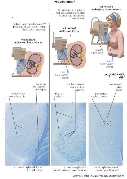 Haga click para ampliar: lo que sucede durante una mamografía