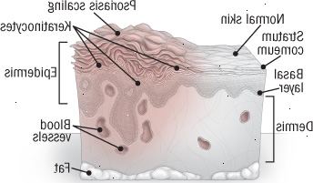 Anatomía de la psoriasis Anatomía de la psoriasis