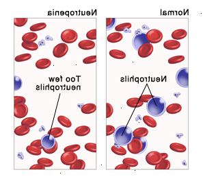 La neutropenia La neutropenia