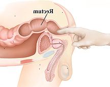 Un tacto rectal puede detectar un crecimiento en el recto o el ano. Un tacto rectal puede detectar un crecimiento en el recto o el ano.