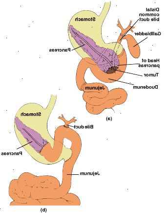 Pancreaticoduodenectomía conservación del píloro: anatomía de la zona resecada (a) y en el tracto digestivo reconectado con pancreaticoyeyunostomía de extremo a extremo (b). Pancreaticoduodenectomía conservación del píloro: anatomía de la zona resecada (a) y en el tracto digestivo reconectado con pancreaticoyeyunostomía de extremo a extremo (b).